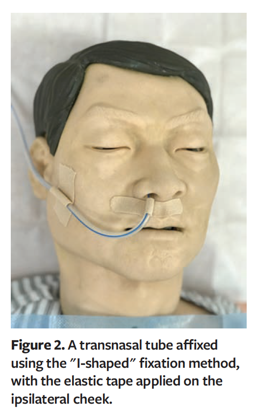 Prevention of HospitalAcquired Transnasal TubeRelated Pressure